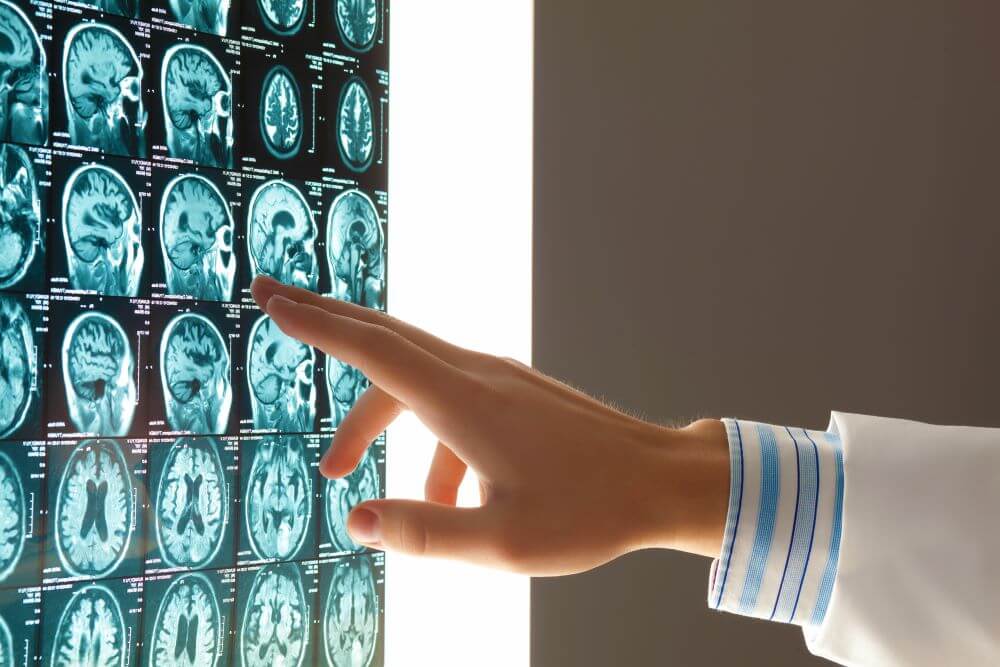 A doctor discussing a traumatic brain injury shown on the X-ray results to a patient.