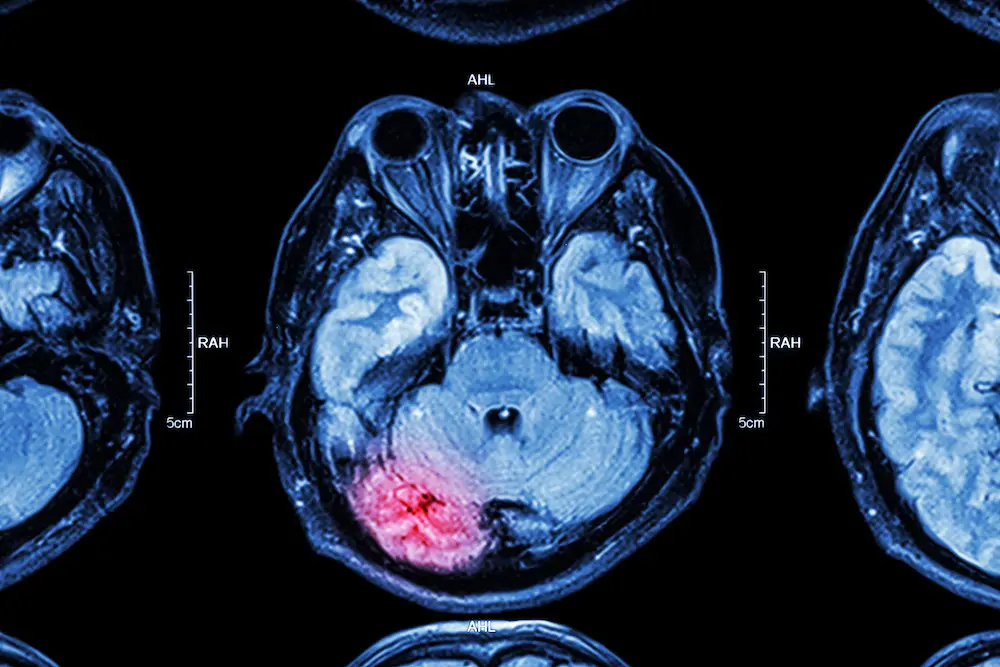 Brain Injury MRI Image