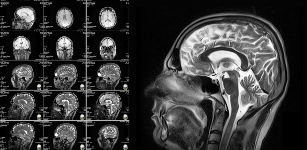 Images of a brain injury used by a brain injury lawyer in florida for a brain injury case.